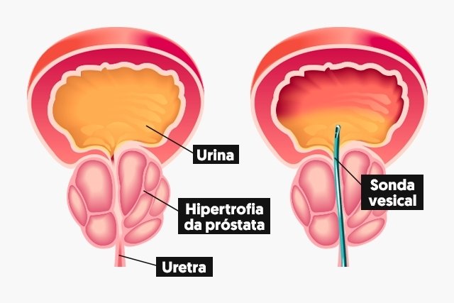 Sonda de demora ou alívio: para que servem, diferenças e riscos
